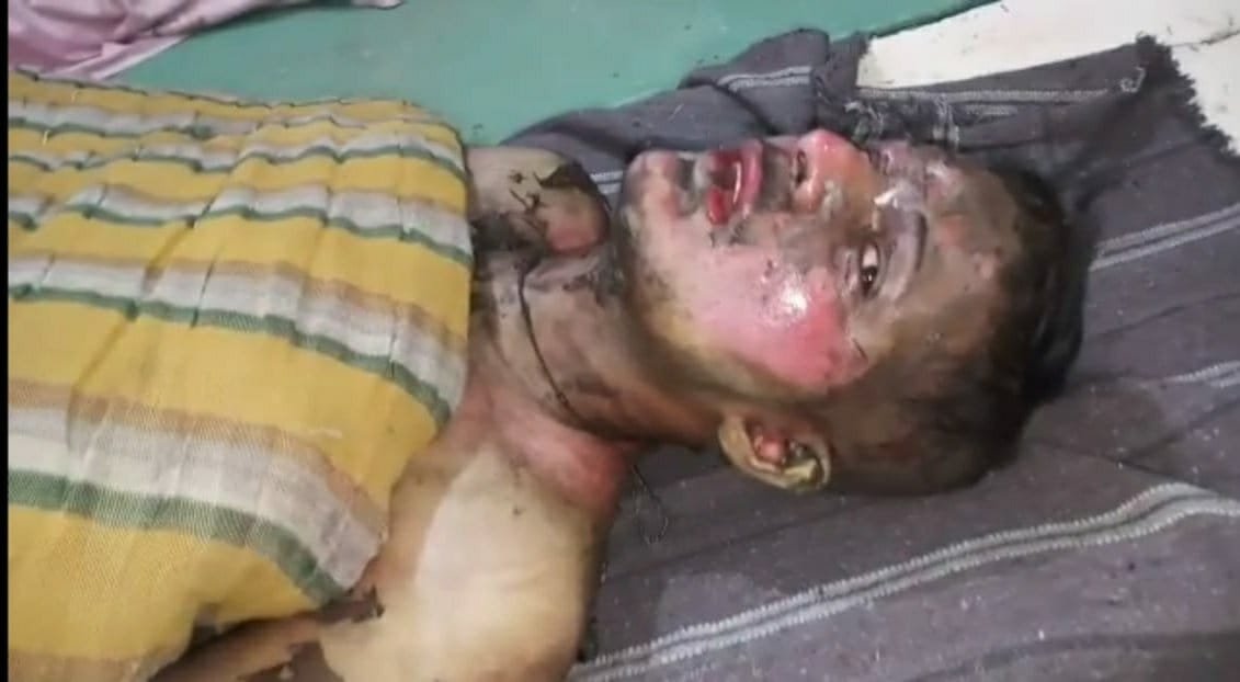 पुरानी रंजिश में युवक को ज़िंदा किया आग के हवाले, युवक की हालत गंभीर | New India Times