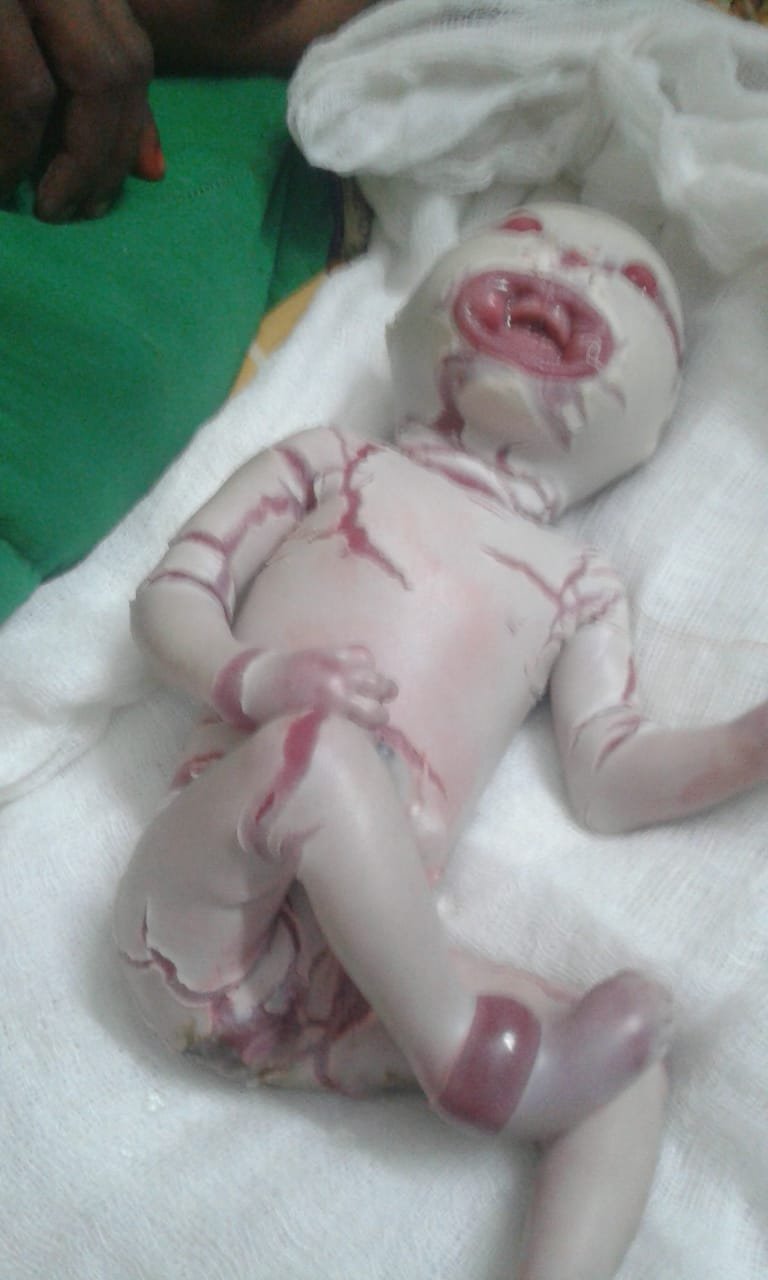 बहराइच जिले की एक महिला ने जन्म दिया कोलोडियन बच्चा, स्वास्थ्य कर्मियों के उड़े होश | New India Times