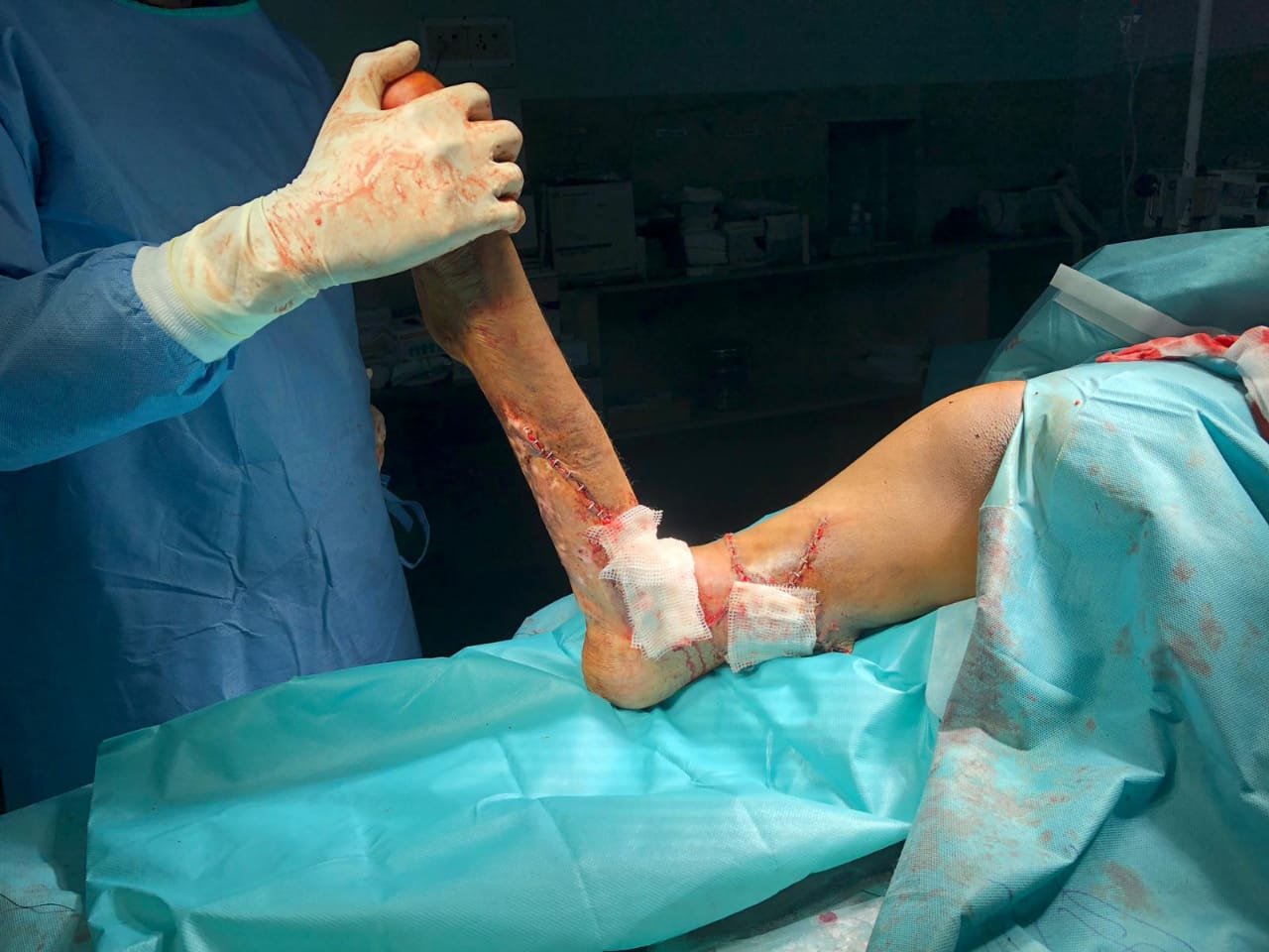 जीवन ज्योति हॉस्पिटल व रोटरी क्लब अपना के तत्वाधान में जारी निःशुल्क प्लास्टिक सर्जरी शिविर इतिहास रचने की ओर है अग्रसर | New India Times