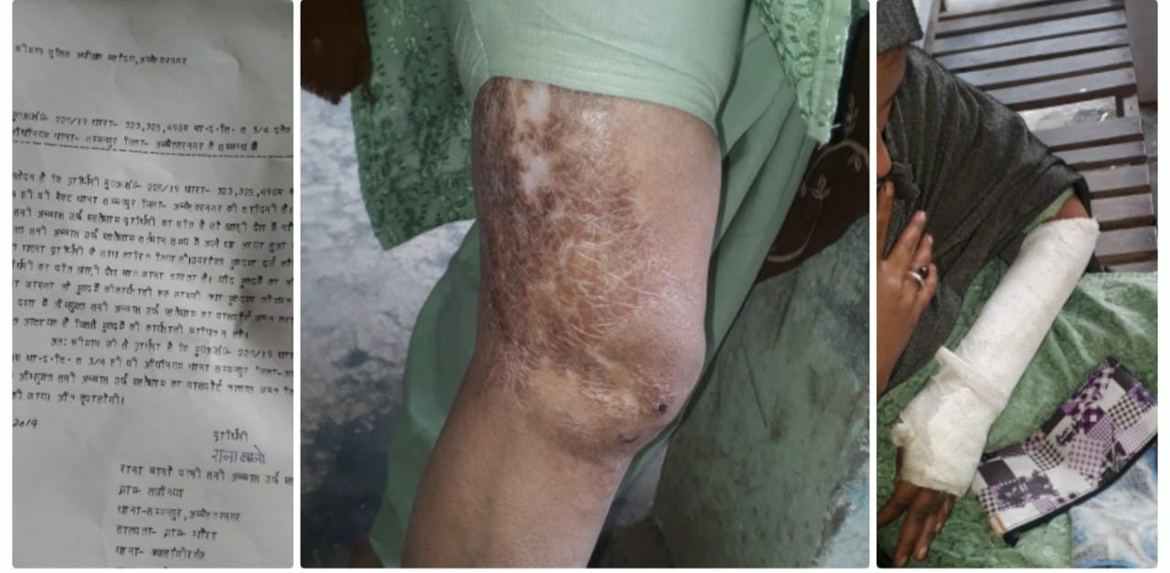 लालची पति ने किया सारी हदों को पार, पहले पत्नी पर खोलता हुआ चाय उंडेला और फिर कुछ दिनों बाद परिजनों के साथ मिलकर पत्नी के हाथ तोड़कर दे दी तलाक, एसपी के निर्देश के बाद भी पुलिस ने दर्ज नहीं की एफआईआर | New India Times