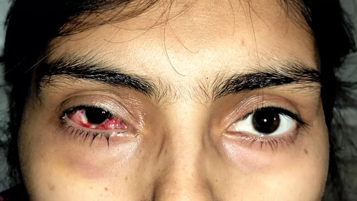 दतिया के लिए भेंगापन (स्क्विंट) अब लाइलाज नहीं: डीन डा. दिनेश उदैनियाँ | New India Times