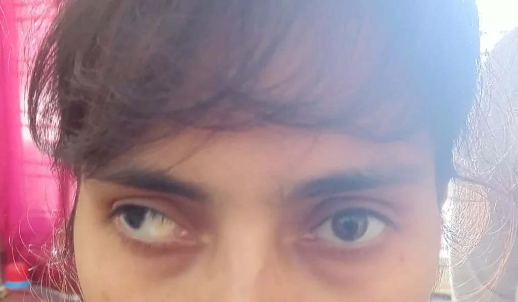 दतिया के लिए भेंगापन (स्क्विंट) अब लाइलाज नहीं: डीन डा. दिनेश उदैनियाँ 2 दतिया के लिए भेंगापन (स्क्विंट) अब लाइलाज नहीं: डीन डा. दिनेश उदैनियाँ | New India Times