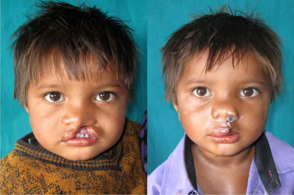 मिशन अस्पताल में कटे होंठ, फटे तलुओं का निःशुल्क सर्जरी कैम्प हुआ संपन्न, अबतक 8000 से अधिक लोगों का हो चुका है निःशुल्क इलाज 3 मिशन अस्पताल में कटे होंठ, फटे तलुओं का निःशुल्क सर्जरी कैम्प हुआ संपन्न, अबतक 8000 से अधिक लोगों का हो चुका है निःशुल्क इलाज | New India Times