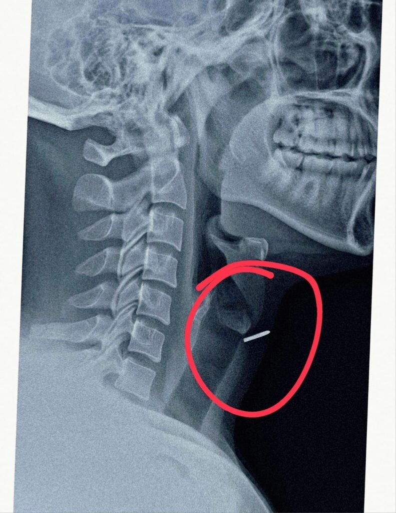 मेडिकल कॉलेज में सर्जरी कर निकाली गई कारपेंटर की गर्दन में घुसी हुई कील, आधुनिक कील लगाने वाली मशीन के खराब होने से हुआ था हादसा | New India Times