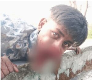 हीरोगिरी पड़ी भारी: मुंह में सुतली बम फोड़ते समय 18 वर्षीय युवक गंभीर रूप से घायल, जबड़ा उड़ा 2 हीरोगिरी पड़ी भारी: मुंह में सुतली बम फोड़ते समय 18 वर्षीय युवक गंभीर रूप से घायल, जबड़ा उड़ा | New India Times