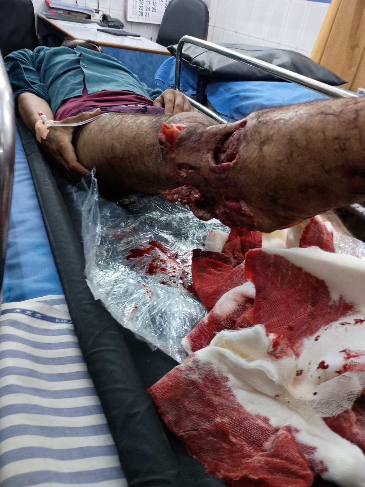 ड्यूटी के दौरान हुआ हादसा, एम्स में कर्मचारी का काटना पड़ रहा है पैर, अब तक नहीं मिली प्रशासन से कोई मदद,कर्मचारी संगठनों में रोष | New India Times