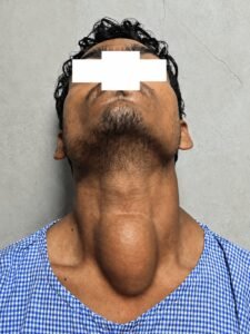 लखीमपुर मेडिकल कॉलेज में गले की जटिल गांठ की सफल सर्जरी, मरीज को मिला नया जीवन